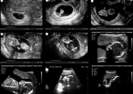 همه چیز درباره سونوگرافی‌ های دوران بارداری
