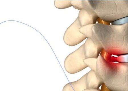 روش‌های درمان دیسک گردن