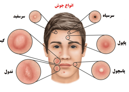 انواع جوش صورت و راهکارهایی معجزه آسا برای درمان آن