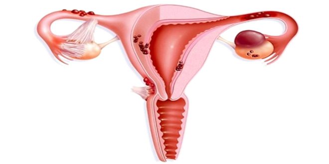 آندومتریوز موجب نازایی زنان می‌شود