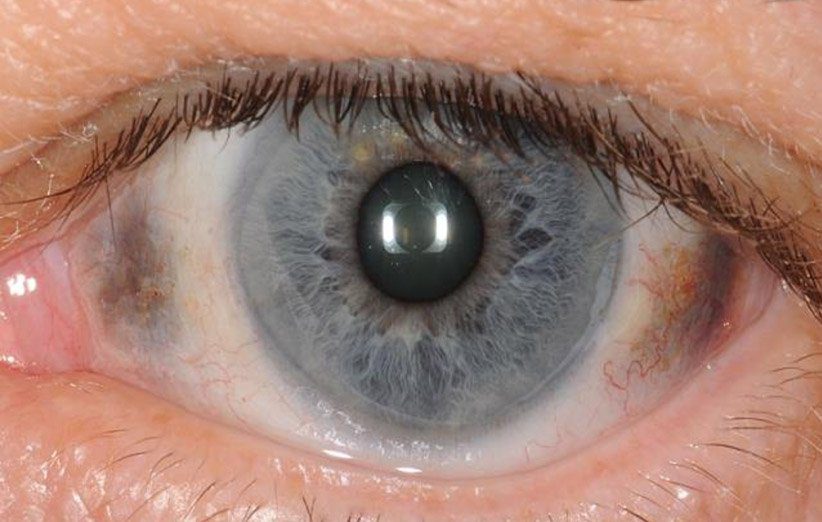 آشنایی با آلکاپتونوریا؛ بیماری عجیبی که رنگ ادرار و چشم را سیاه می‌کند