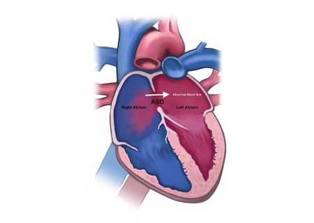 نقص سپتوم دهلیزی یا ASD چیست؟