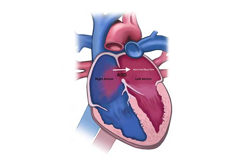 نقص سپتوم دهلیزی یا ASD چیست؟