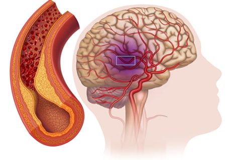 آمبولی مغزی چیست؟