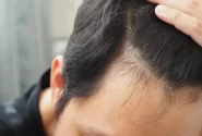 هایفوتراپی مو چیست و چقدر تاثیر دارد؟