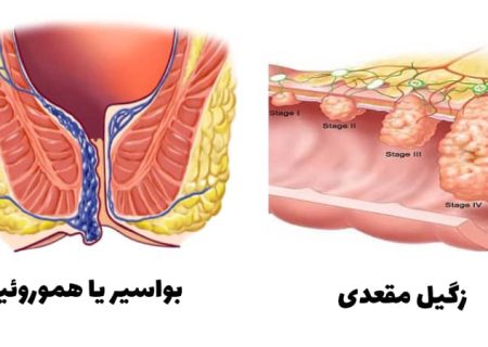 زگیل مقعدی چیست؟