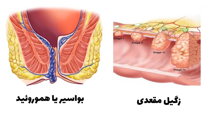 زگیل مقعدی چیست؟