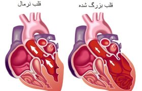 گشادی قلب؛ آشنایی کامل با این بیماری