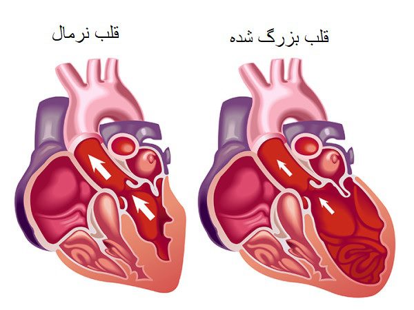 گشادی قلب؛ آشنایی کامل با این بیماری