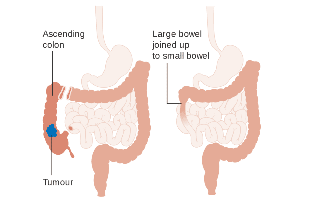 عمل کولکتومی (Colectomy) چیست؟