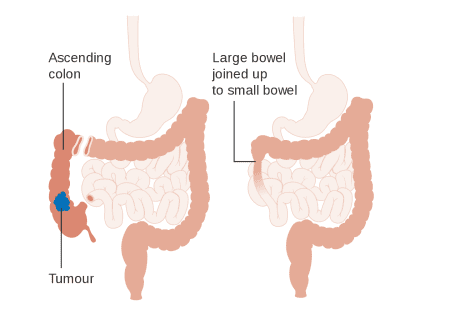 عمل کولکتومی (Colectomy) چیست؟