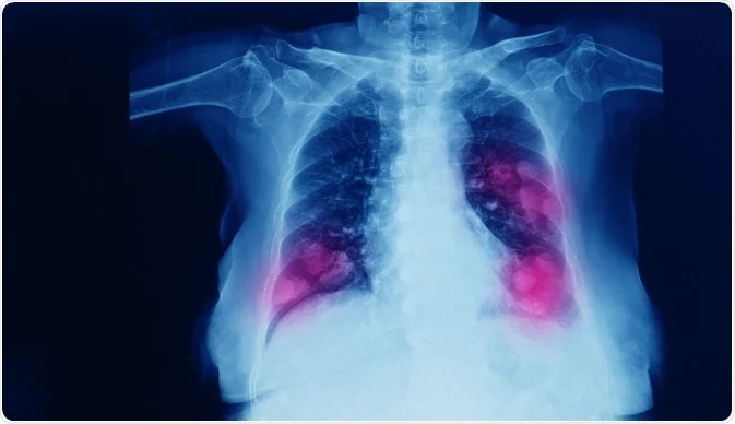 متاستاز ریه چیست و چگونه درمان می‌شود؟