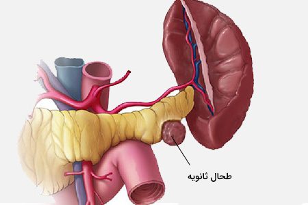 منظور از طحال فرعی چیست؟