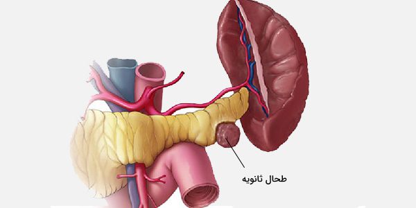 منظور از طحال فرعی چیست؟