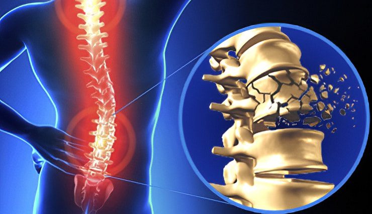 آسیب نخاعی چیست و چه علائمی دارد؟