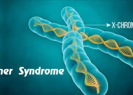 با سندروم ترنر بیش‌تر آشنا شوید