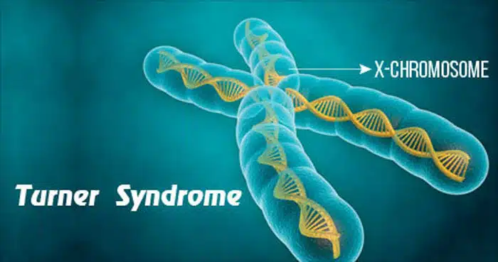 با سندروم ترنر بیش‌تر آشنا شوید