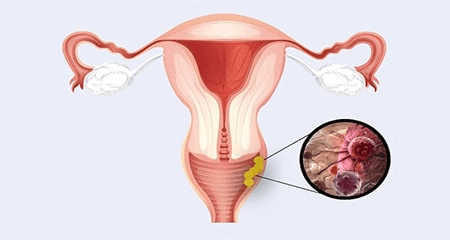 عفونت قارچی واژن چگونه است و چه علائمی دارد؟