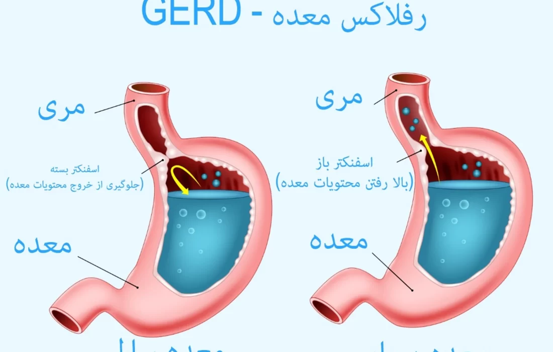 کدام دمنوش برای رفلاکس معده خوب است؟