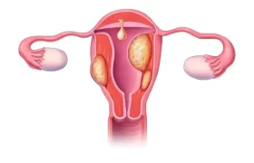معجزه درمان فیبروم رحمی چیست؟