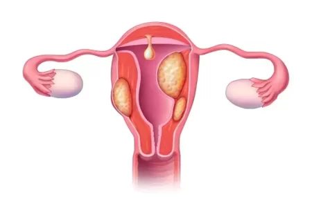معجزه درمان فیبروم رحمی چیست؟