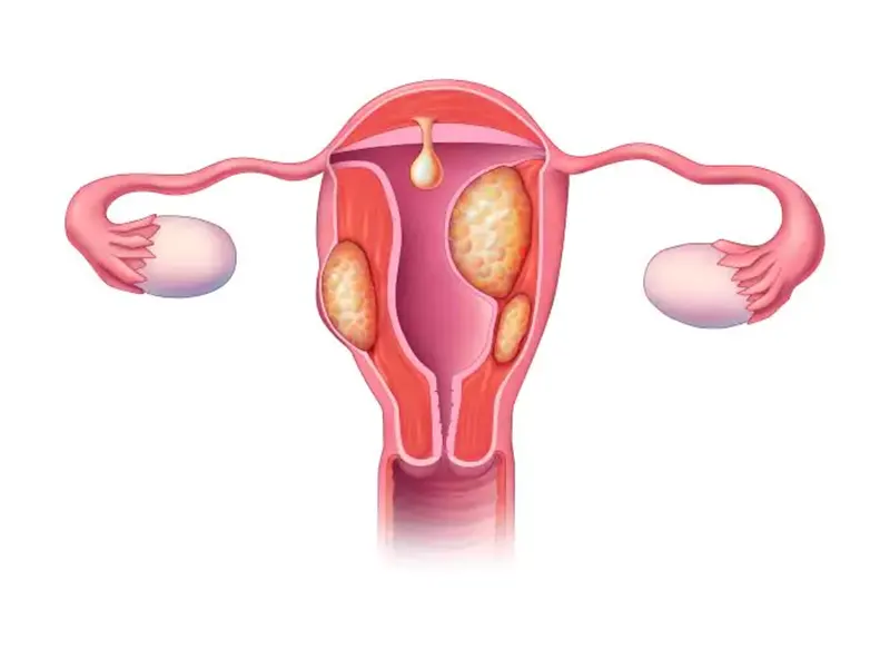 معجزه درمان فیبروم رحمی چیست؟