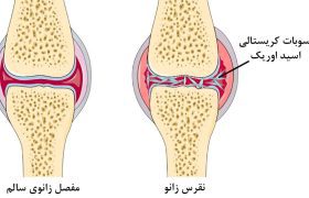 نقرس زانو چیست؟