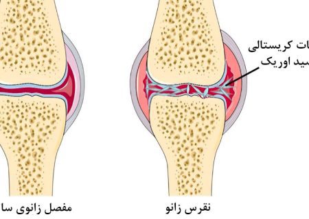 نقرس زانو چیست؟