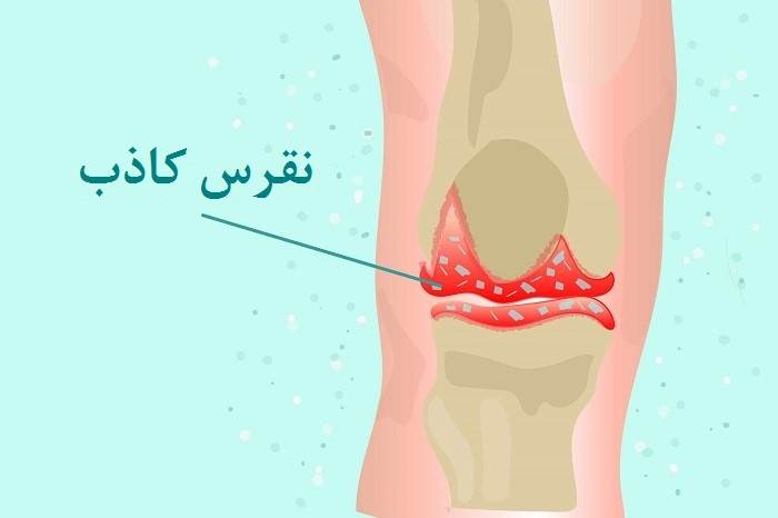 نقرس کاذب چیست؟